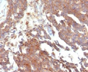 IHC testing of FFPE human ovarian carcinoma and GnRHR antibody (clone LCHR37). Staining of formalin-