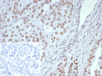 IHC staining of FFPE human ovarian cancer tissue with ARID1A antibody (clone ARID1A/7735). Inset: PB