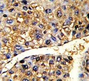 IHC testing of FFPE human hepatocellular carcinoma tissue with TUFM antibody. HIER: steam section in