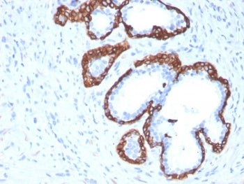IHC staining of FFPE human prostate carcinoma with Cytokeratin 5 antibody (clone KRT5/3594). HIER: b