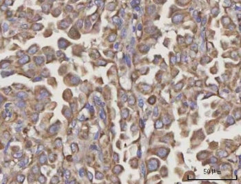 IHC staining of FFPE human lung cancer tissue with NDUFA4 antibody. HIER: boil tissue sections in pH