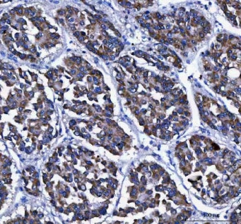 IHC staining of FFPE human liver cancer tissue with LGI4 antibody. HIER: boil tissue sections in pH8