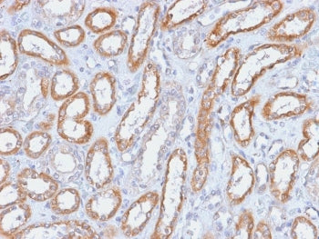 IHC testing of FFPE human renal cell carcinoma with Integrin beta 3 antibody (clone ITGB3/2166R). Re