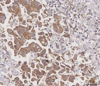 IHC staining of FFPE human liver cancer tissue with MGAT3 antibody. HIER: boil tissue sections in pH