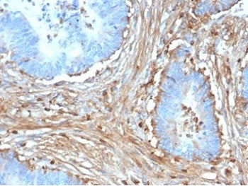 IHC staining of FFPE human colon carcinoma with Fibrillin 1 antibody (clone FBN1/6933). HIER: boil t