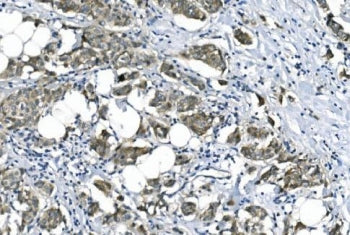 IHC staining of FFPE human breast cancer with eRF1 antibody. HIER: boil tissue sections in pH8 EDTA 