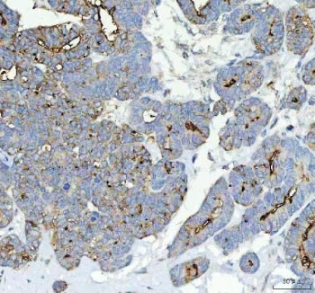 IHC staining of FFPE human parotid acinar cell carcinoma tissue with Alkaline Phosphatase antibody. 