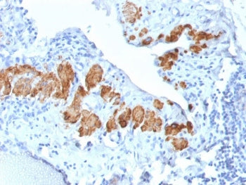 IHC testing of FFPE human breast carcinoma with recombinant SMMHC antibody (clone MYH11/2303R). Requ