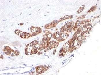 IHC: Formalin-fixed, paraffin-embedded human breast carcinoma stained with anti-Cytokeratin 18 antib