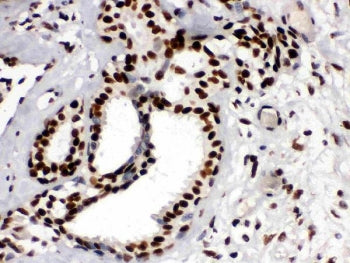IHC testing of FFPE human breast cancer tissue with TRIM28 antibody. HIER: Boil the paraffin section