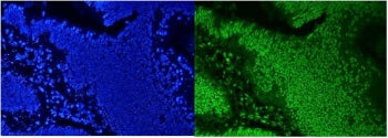 Immunofluorescent staining of FFPE human intestinal cancer with AUF1 antibody (green) and DAPI nucle