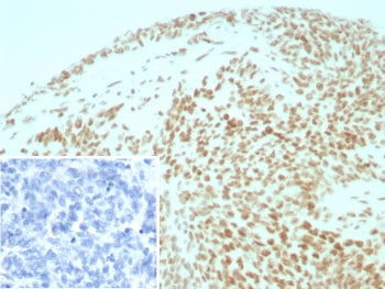IHC staining of FFPE human ovarian cancer tissue with SMARCB1 antibody (clone INI1/8935R) Inset: PBS