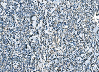 IHC staining of FFPE human lymphoma tissue with C-C chemokine receptor type 2 antibody. HIER: boil t
