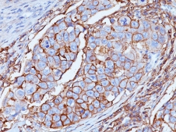 IHC analysis of formalin-fixed, paraffin-embedded human breast carcinoma stained with CD44 antibody 