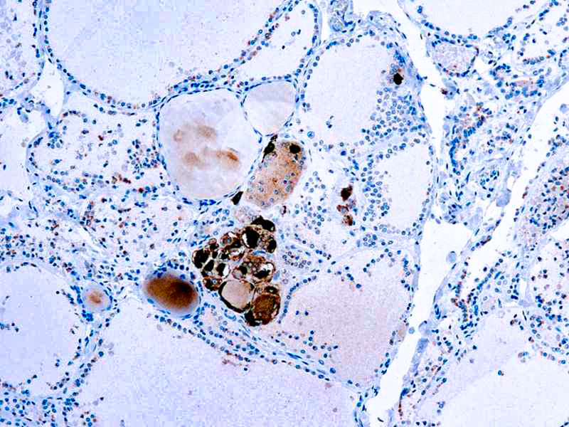 Calcitonin