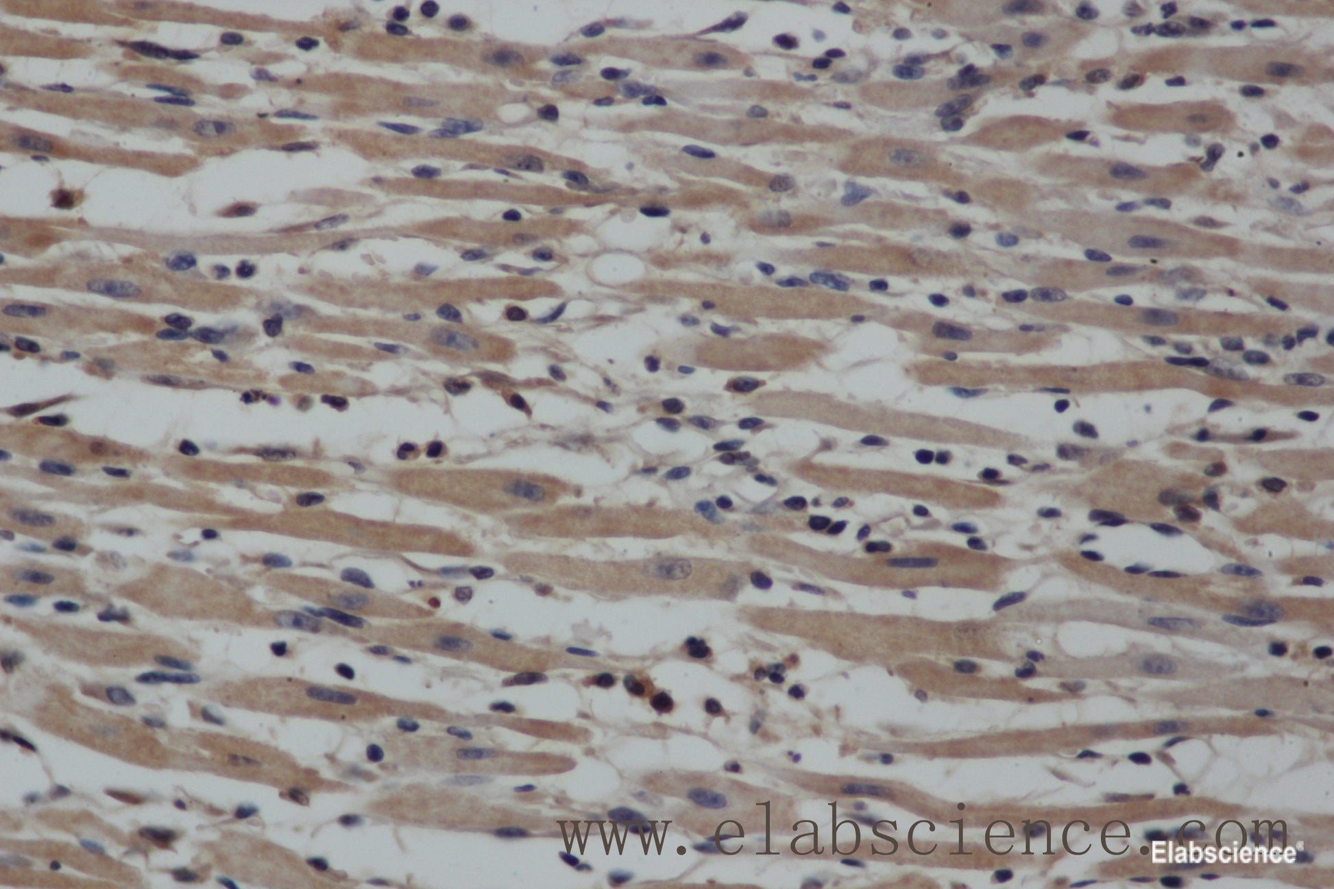 Immunohistochemistry of paraffin-embedded Human gasrtic cancer tissue using NOS2 Polyclonal Antibody at dilution 1:40