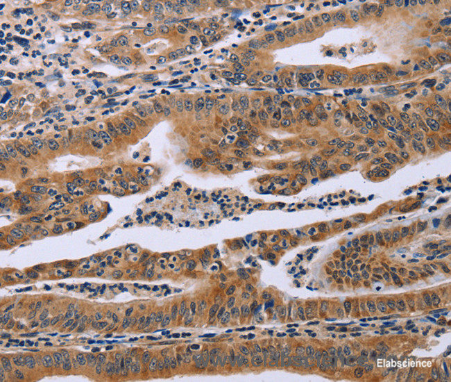 Immunohistochemistry of paraffin-embedded Human gasrtic cancer tissue using FAF1 Polyclonal Antibody at dilution 1:40