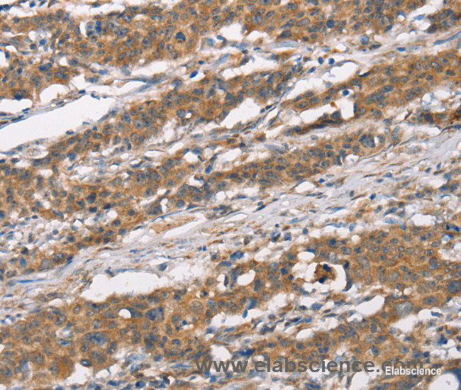 Immunohistochemistry of paraffin-embedded Human thyroid cancer using MARC1 Polyclonal Antibody at dilution of 1:40