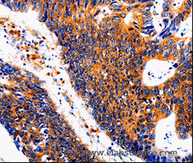Immunohistochemistry of paraffin-embedded Human colon cancer tissue using IL18BP Polyclonal Antibody at dilution 1:50