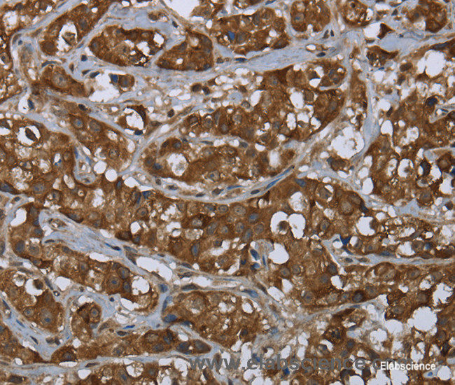 Immunohistochemistry of paraffin-embedded Human breast cancer tissue using PIP Polyclonal Antibody at dilution 1:50