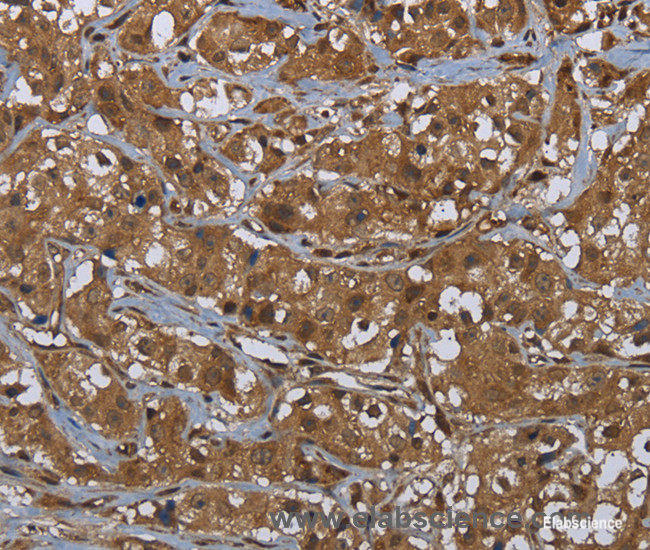 Immunohistochemistry of paraffin-embedded Human breast cancer tissue using GCK Polyclonal Antibody at dilution 1:60