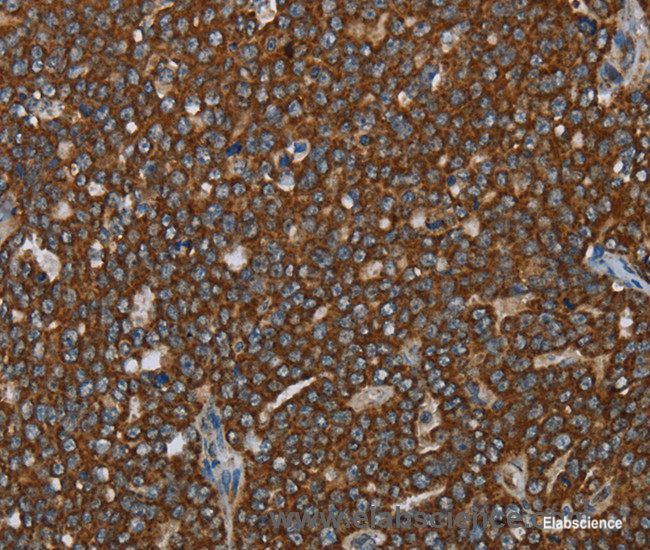 Immunohistochemistry of paraffin-embedded Human ovarian cancer tissue using GCKR Polyclonal Antibody at dilution 1:40