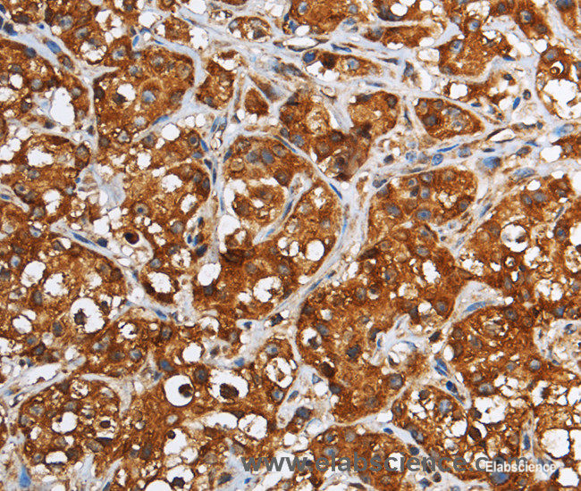 Immunohistochemistry of paraffin-embedded Human breast cancer tissue using GGCX Polyclonal Antibody at dilution 1:60
