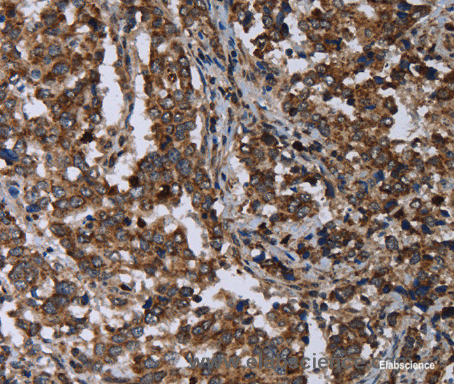 Immunohistochemistry of paraffin-embedded Human liver cancer tissue using DNAJC15 Polyclonal Antibody at dilution 1:40