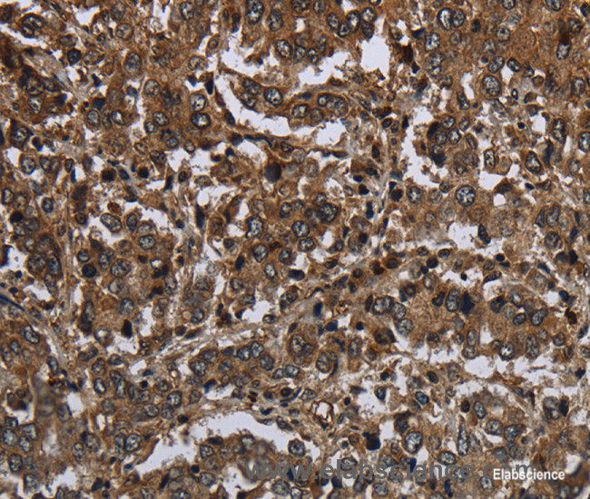 Immunohistochemistry of paraffin-embedded Human liver cancer tissue using GLIPR1 Polyclonal Antibody at dilution 1:50