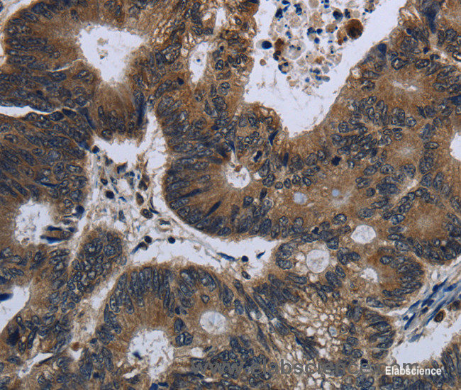Immunohistochemistry of paraffin-embedded Human colon cancer tissue using GK1 Polyclonal Antibody at dilution 1:60