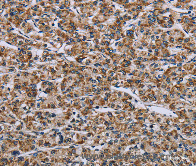 Immunohistochemistry of paraffin-embedded Human prostate cancer tissue using GTPBP10 Polyclonal Antibody at dilution 1:60