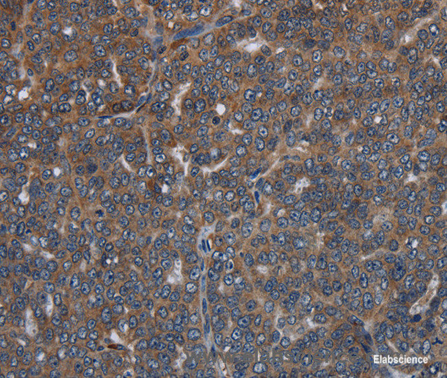 Immunohistochemistry of paraffin-embedded Human ovarian cancer tissue using LETMD1 Polyclonal Antibody at dilution 1:30