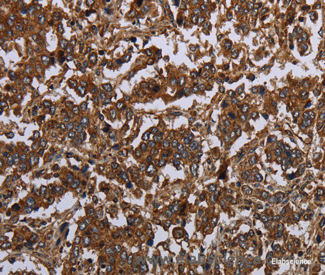 Immunohistochemistry of paraffin-embedded Human liver cancer tissue using HOMER2 Polyclonal Antibody at dilution 1:30