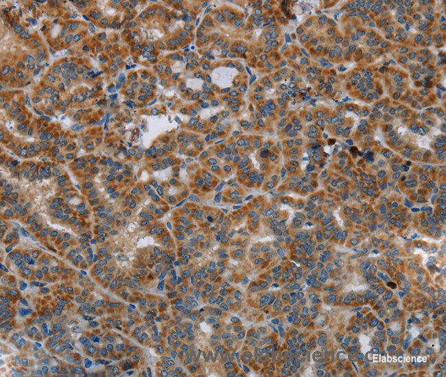 Immunohistochemistry of paraffin-embedded Human thyroid cancer tissue using HSD17B14 Polyclonal Antibody at dilution 1:40