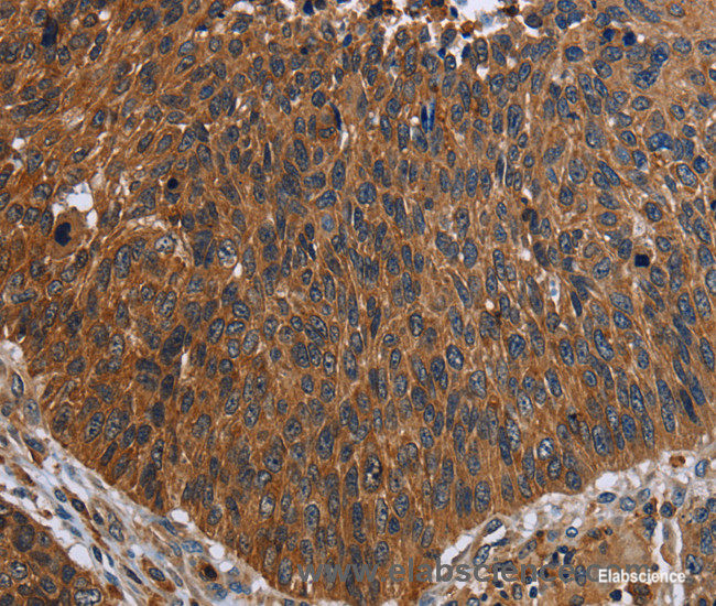 Immunohistochemistry of paraffin-embedded Human lung cancer tissue using FCGR3A Polyclonal Antibody at dilution 1:60