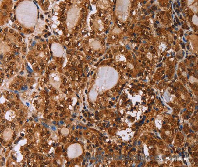 Immunohistochemistry of paraffin-embedded Human thyroid cancer tissue using IHH Polyclonal Antibody at dilution 1:50