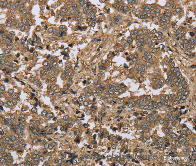 Immunohistochemistry of paraffin-embedded Human liver cancer tissue using IKBIP Polyclonal Antibody at dilution 1:30