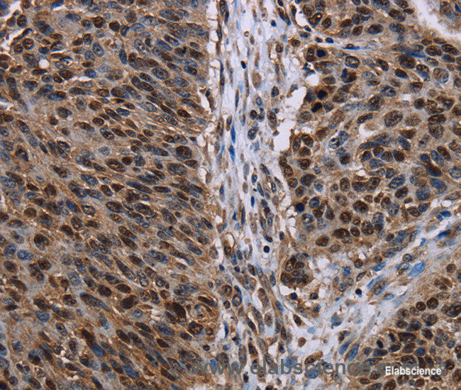 Immunohistochemistry of paraffin-embedded Human lung cancer tissue using KDM3B Polyclonal Antibody at dilution 1:50