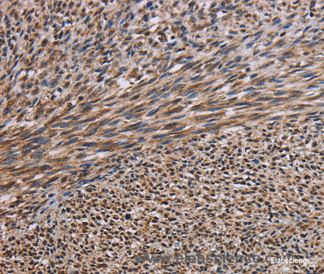 Immunohistochemistry of paraffin-embedded Human sarcoma tissue using KIF2A Polyclonal Antibody at dilution 1:30