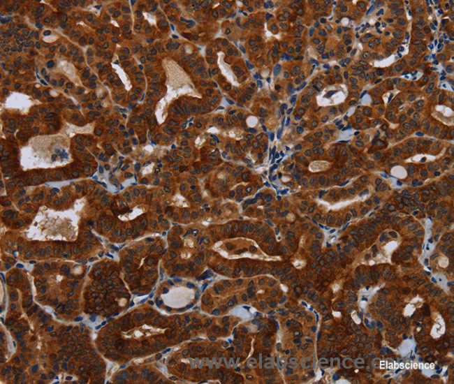 Immunohistochemistry of paraffin-embedded Human thyroid cancer tissue using KLHL1 Polyclonal Antibody at dilution 1:30