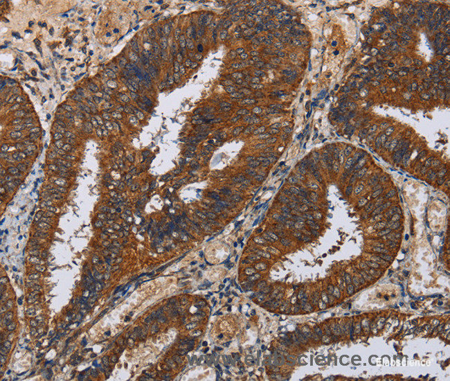 Immunohistochemistry of paraffin-embedded Human colon cancer tissue using KLK11 Polyclonal Antibody at dilution 1:50