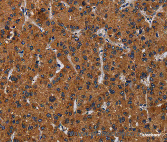 Immunohistochemistry of paraffin-embedded Human liver cancer tissue using KLK8 Polyclonal Antibody at dilution 1:50