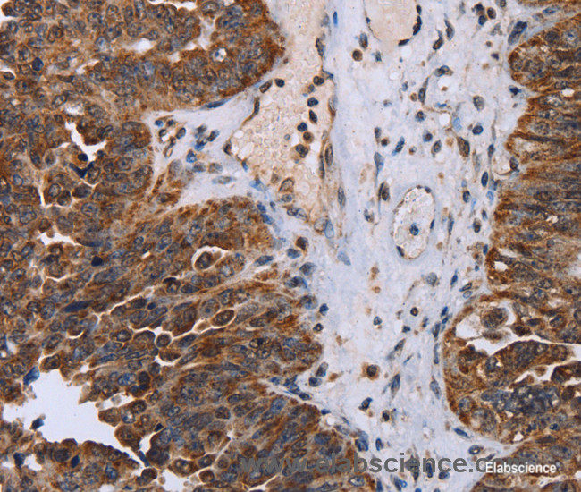 Immunohistochemistry of paraffin-embedded Human ovarian cancer tissue using DDX11 Polyclonal Antibody at dilution 1:30