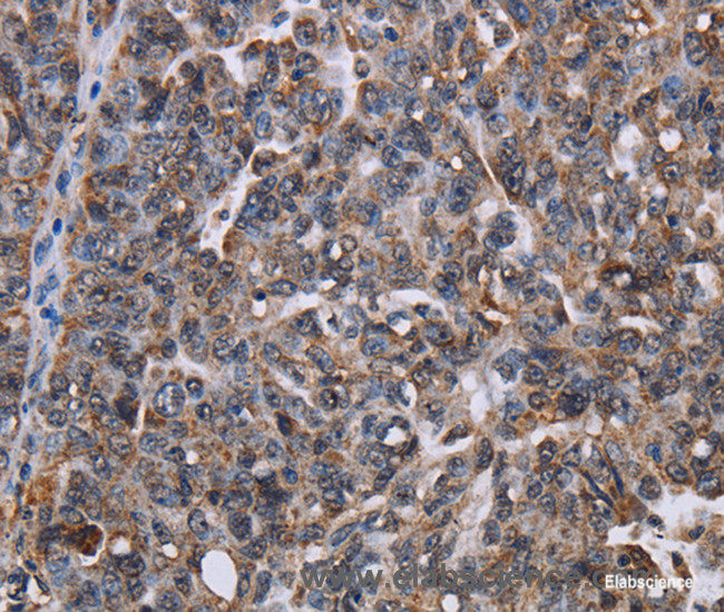 Immunohistochemistry of paraffin-embedded Human ovarian cancer tissue using LDOC1 Polyclonal Antibody at dilution 1:50