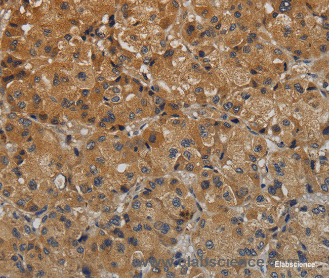 Immunohistochemistry of paraffin-embedded Human liver cancer tissue using TAB1 Polyclonal Antibody at dilution 1:40
