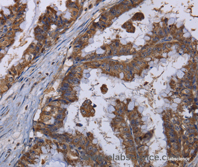 Immunohistochemistry of paraffin-embedded Human esophagus cancer tissue using MT3 Polyclonal Antibody at dilution 1:50
