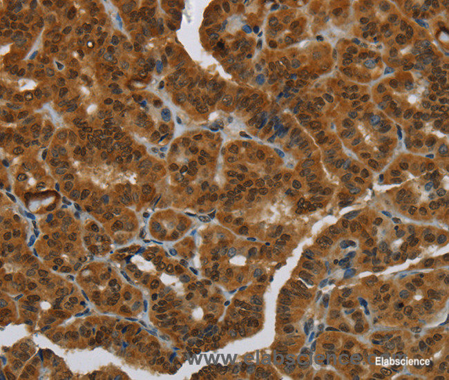 Immunohistochemistry of paraffin-embedded Human thyroid cancer tissue using MRE11 Polyclonal Antibody at dilution 1:60