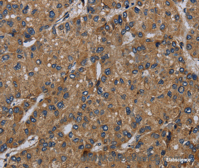Immunohistochemistry of paraffin-embedded Human liver cancer tissue using NDUFS6 Polyclonal Antibody at dilution 1:50