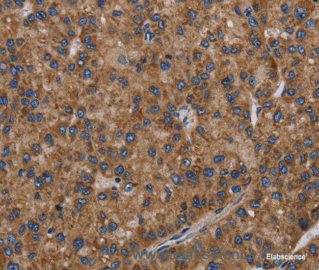 Immunohistochemistry of paraffin-embedded Human liver cancer tissue using NECTIN2 Polyclonal Antibody at dilution 1:40