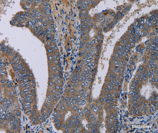 Immunohistochemistry of paraffin-embedded Human colon cancer tissue using NECTIN4 Polyclonal Antibody at dilution of 1:40